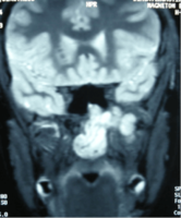 Juvenile nasopharyngeal angiofibroma
