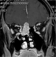 Olfactory neuroblastoma (esthesioneuroblastoma)