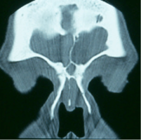 Nasal polyposis- Chronic rhinosinusitis with nasal polyps